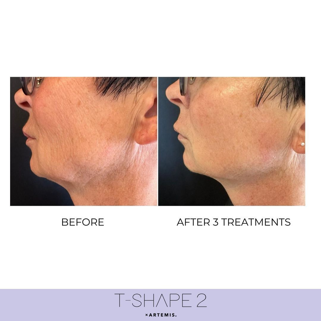 An Artemis T-Shape 2 before and after of a woman's face.