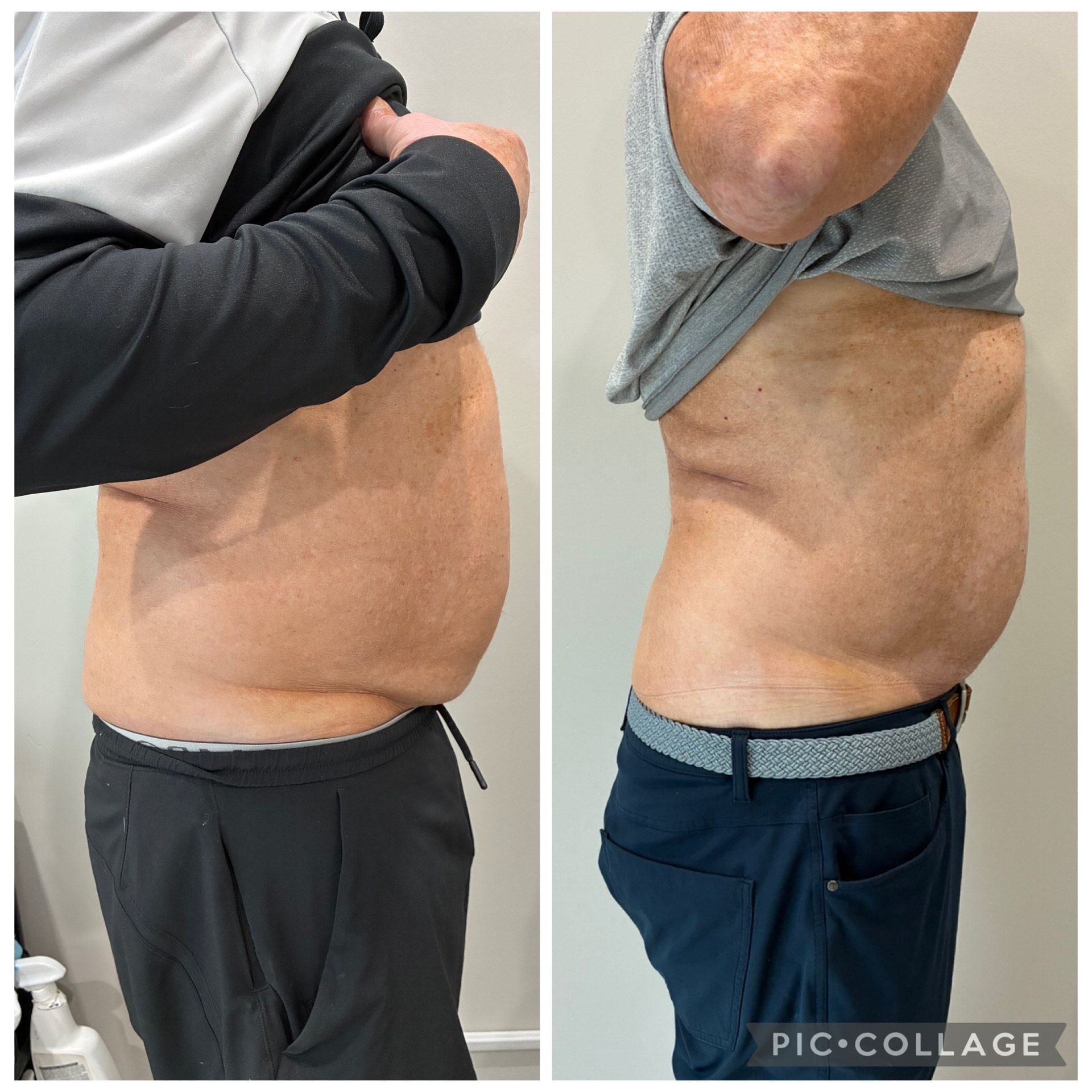 An Artemis T-Shape 2 before and after of a man's midsection.