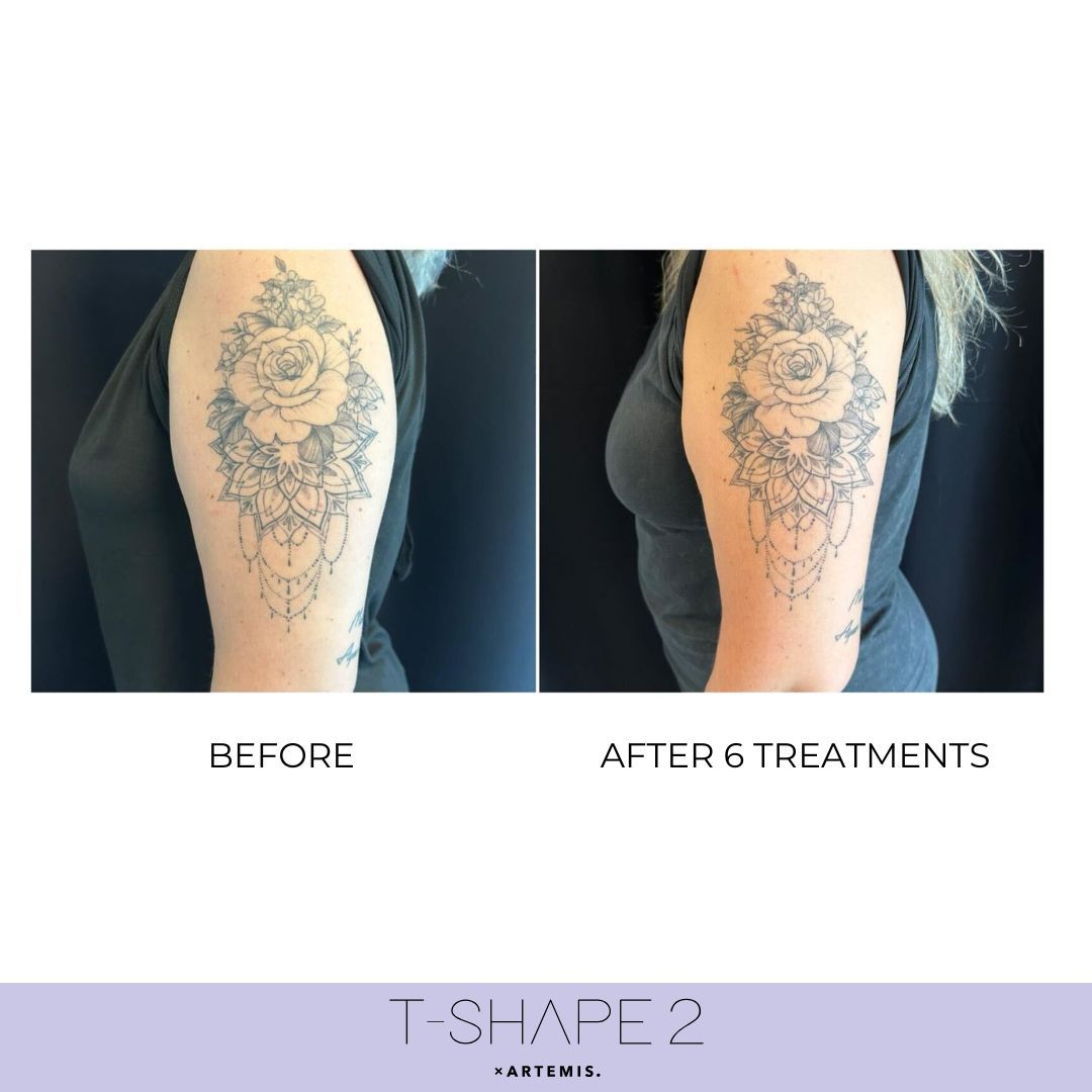 An Artemis T-Shape 2 before and after of a woman's arms.