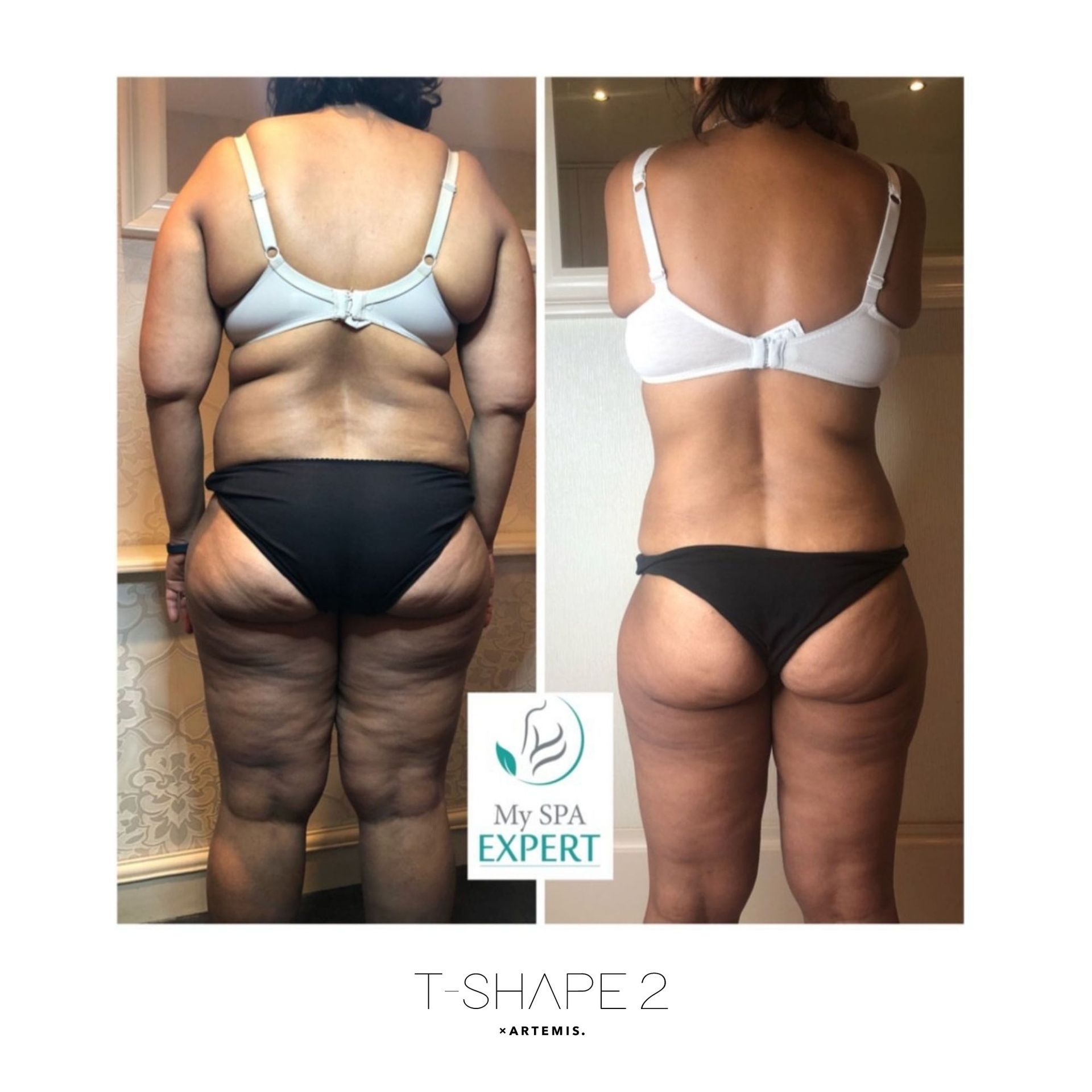An Artemis T-Shape 2 before and after of a woman's glutes.