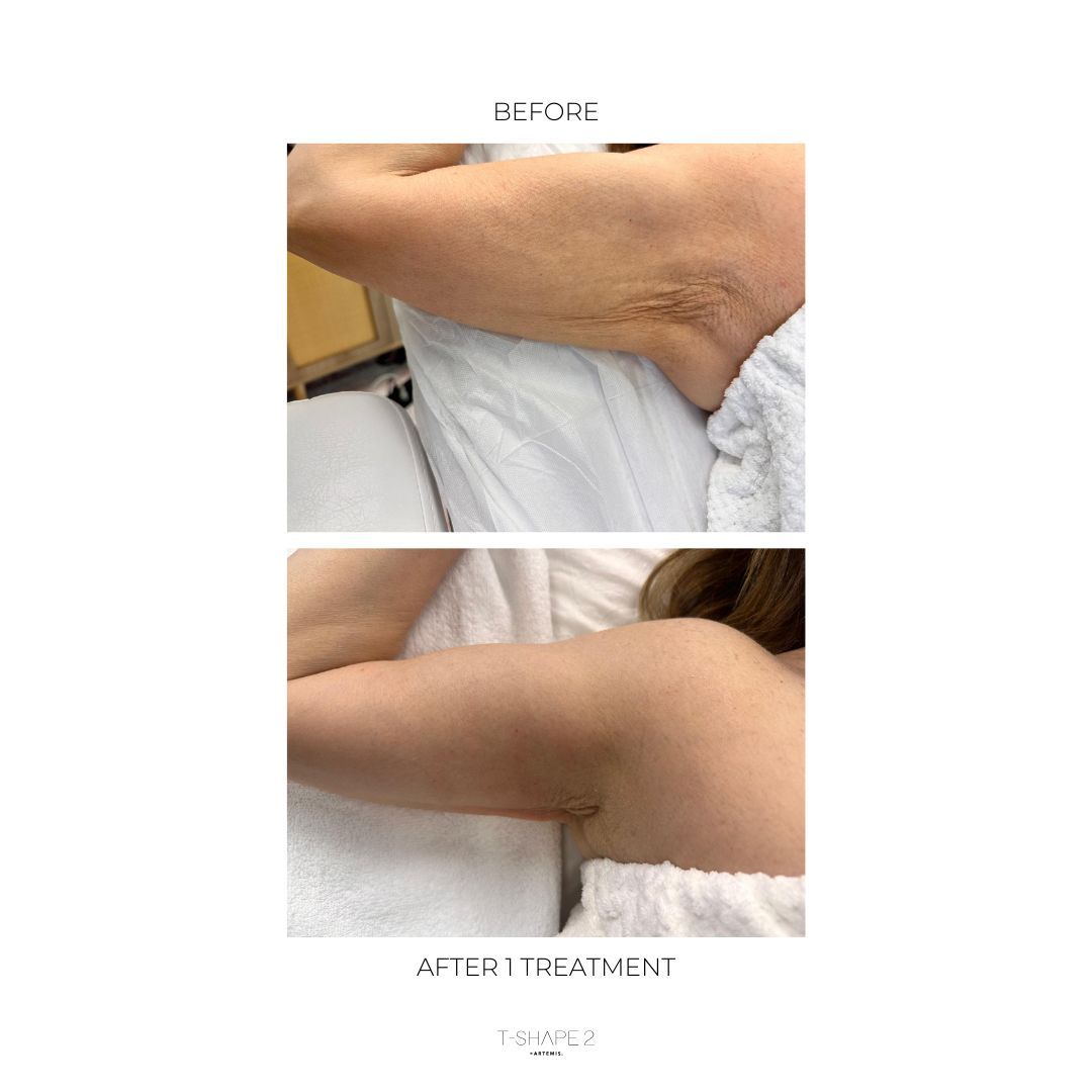 An Artemis T-Shape 2 before and after of a woman's arms.
