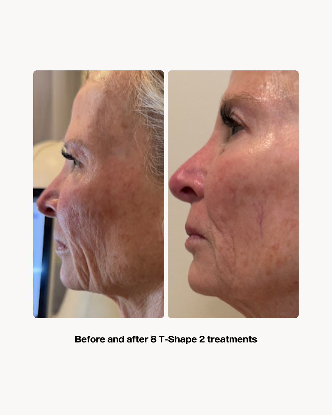An Artemis T-Shape 2 before and after of a woman's face.