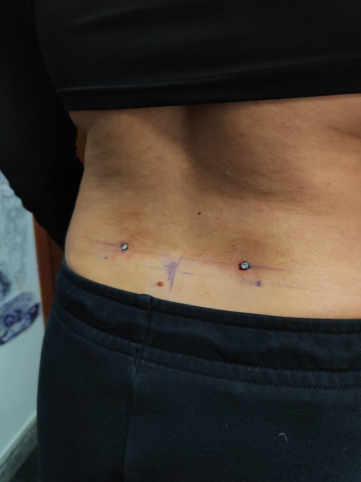 Parte bassa della schiena con una cicatrice chirurgica orizzontale recente e due piccoli piercing ai lati.