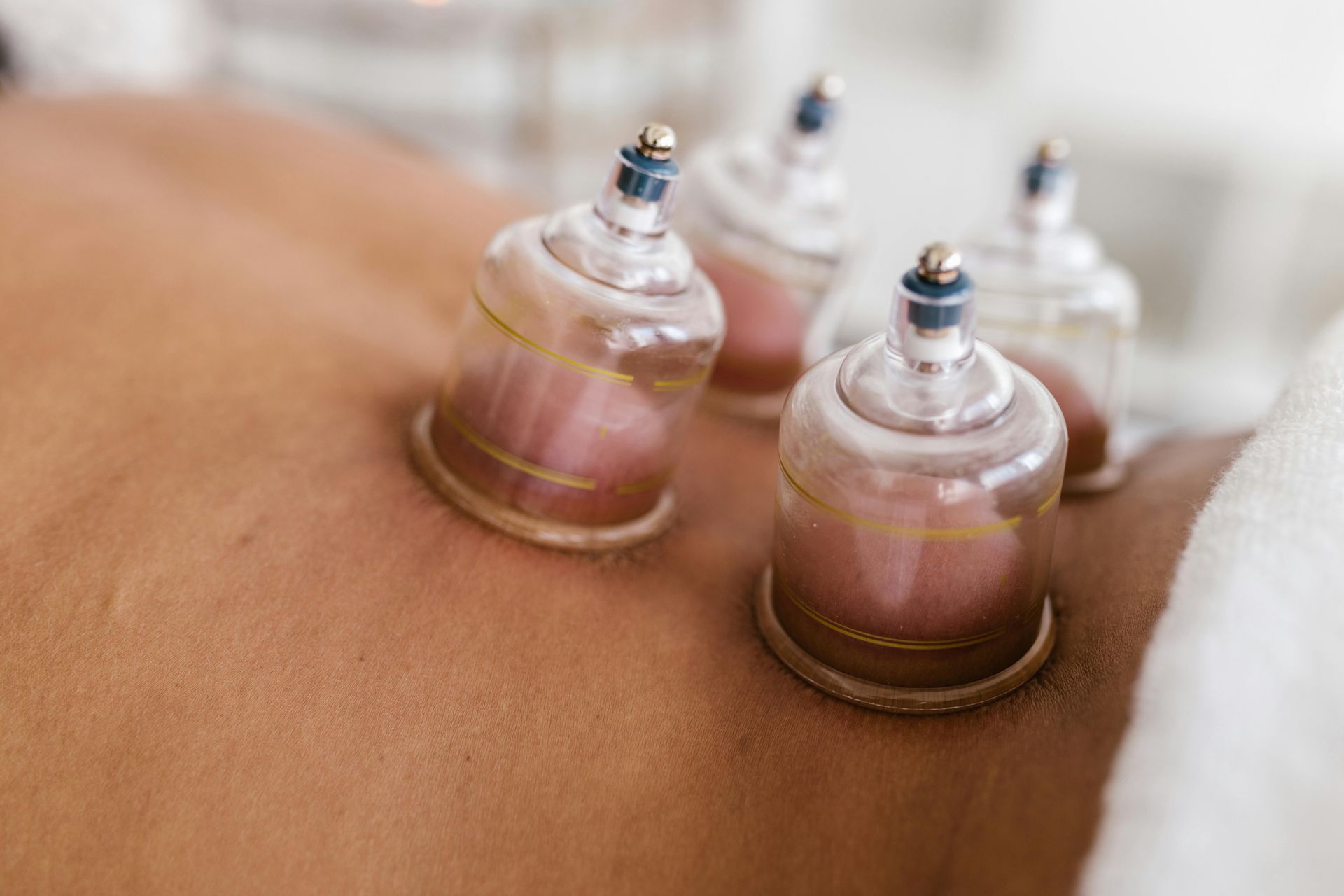 A person is getting cupping treatment on their back.