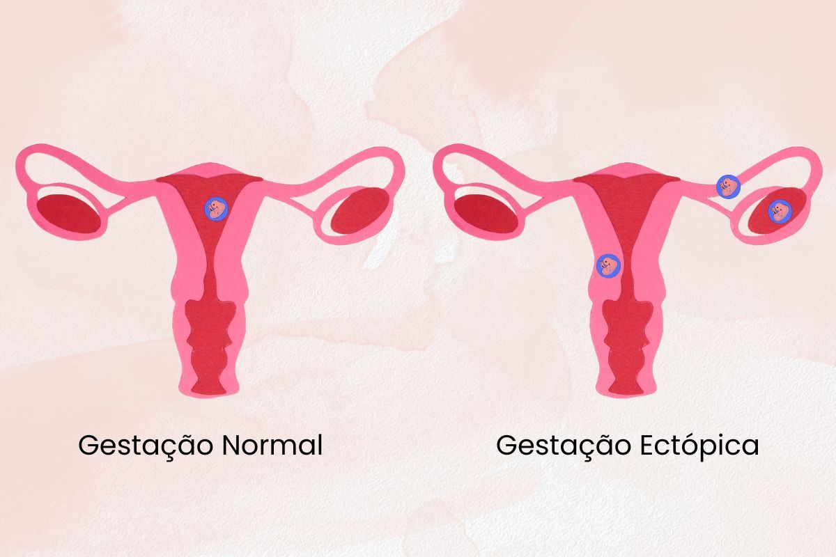 Gestação ectópica: o que é e como identificar?