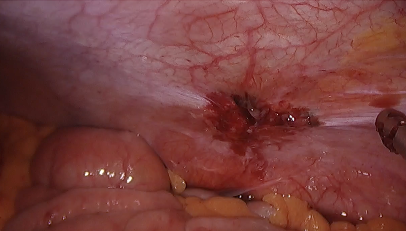 Nódulo de parede de goteira parietocolica esquerda
Realizado exérese de nódulo. Médica Especialista em Endometriose!
