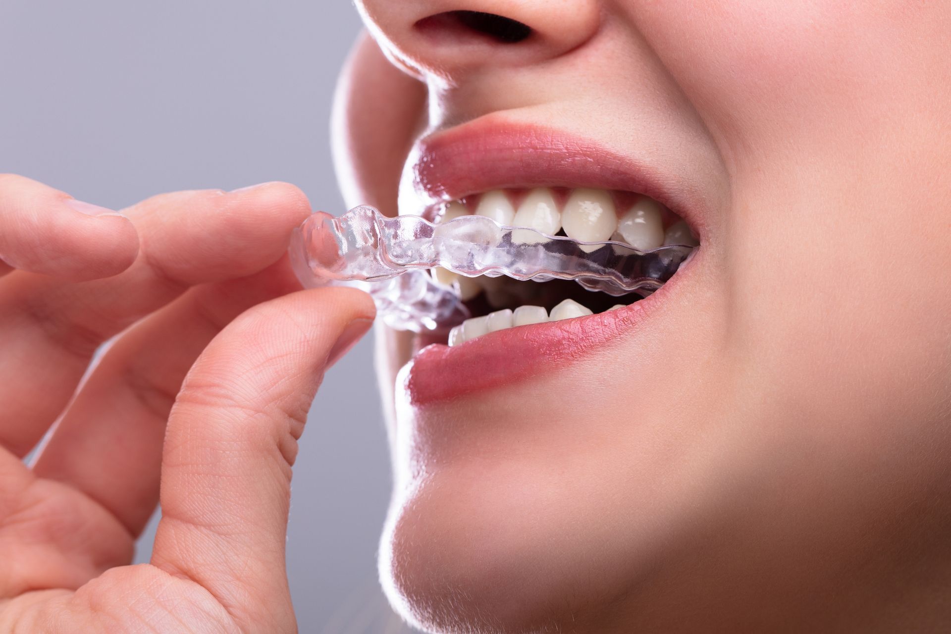 Primer plano de una mano colocando un alineador transparente en los dientes de una persona.
