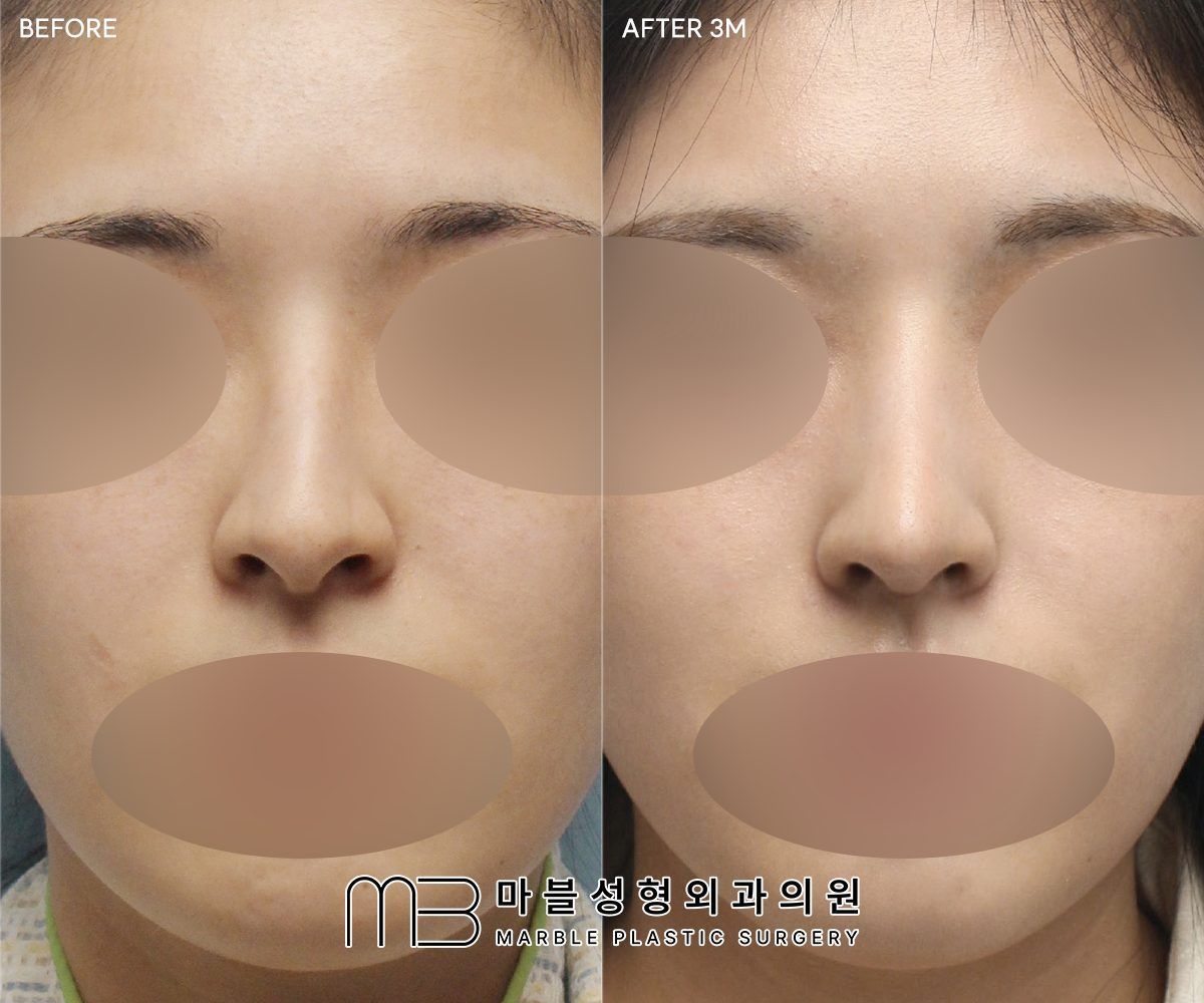 Before and after Tip plasty + dorsal hump reduction + double eyelid surgery (natural adhesion), front view, 3 months after surgery — case 01, Marble Plastic Surgery Seoul