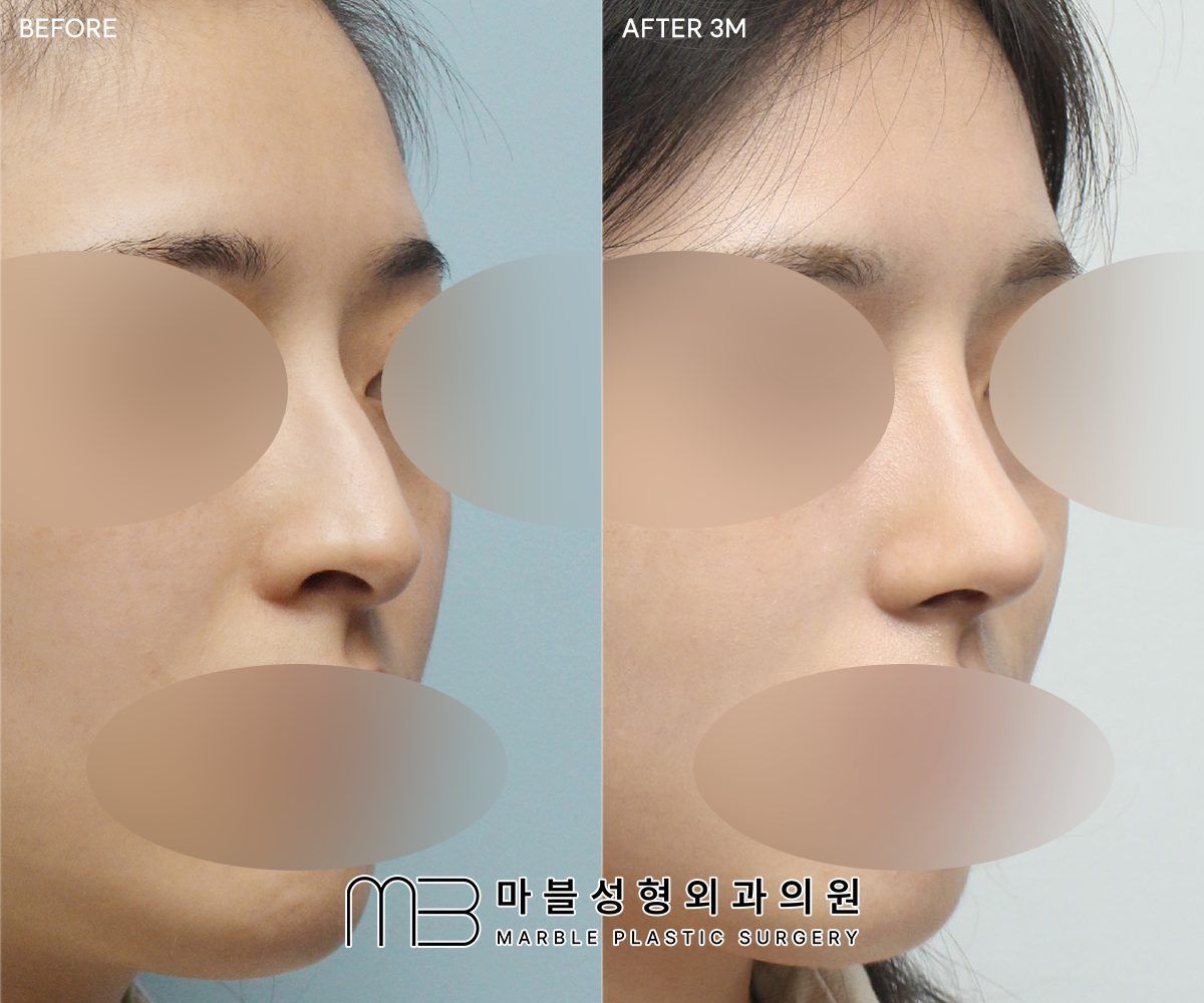 Before and after Tip plasty + dorsal hump reduction + double eyelid surgery (natural adhesion), 45° view, 3 months after surgery — case 01, Marble Plastic Surgery Seoul