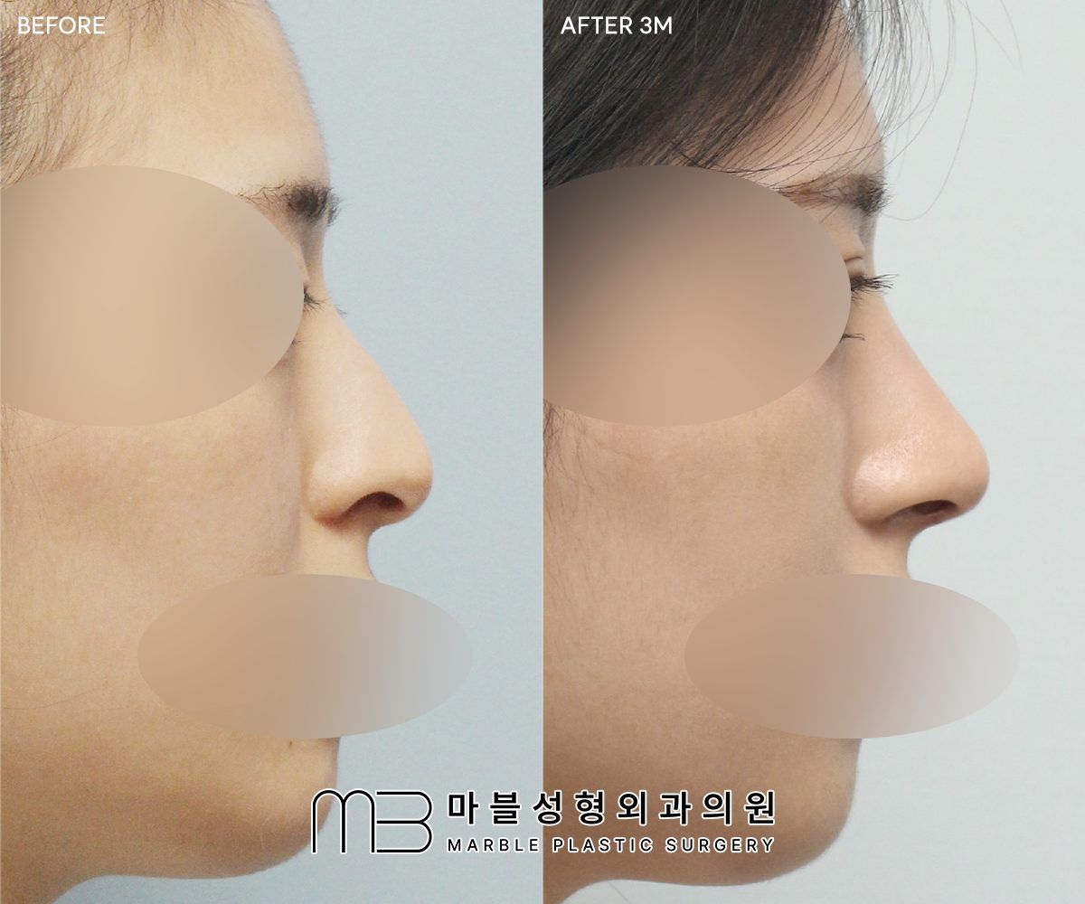 Before and after Tip plasty + dorsal hump reduction + double eyelid surgery (natural adhesion), side profile, 3 months after surgery — case 01, Marble Plastic Surgery Seoul
