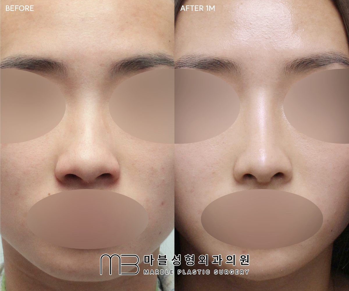 Before and after Rhinoplasty (bridge + tip) + bulbous tip correction + dorsal hump reduction + lateral osteotomy, front view, 1 month after surgery — case 02, Marble Plastic Surgery Seoul