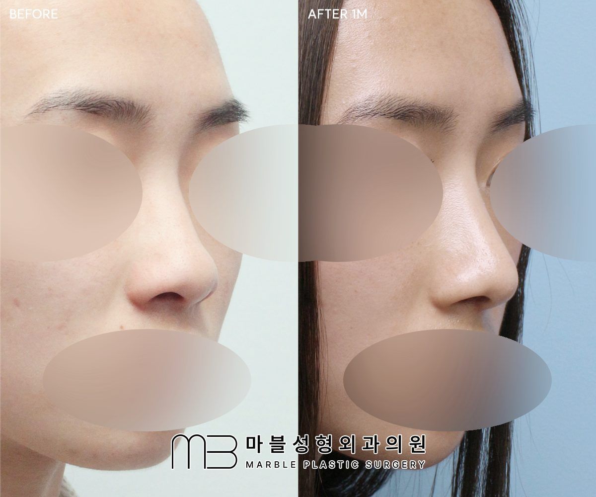 Before and after Rhinoplasty (bridge + tip) + bulbous tip correction + dorsal hump reduction + lateral osteotomy, 45° view, 1 month after surgery — case 02, Marble Plastic Surgery Seoul