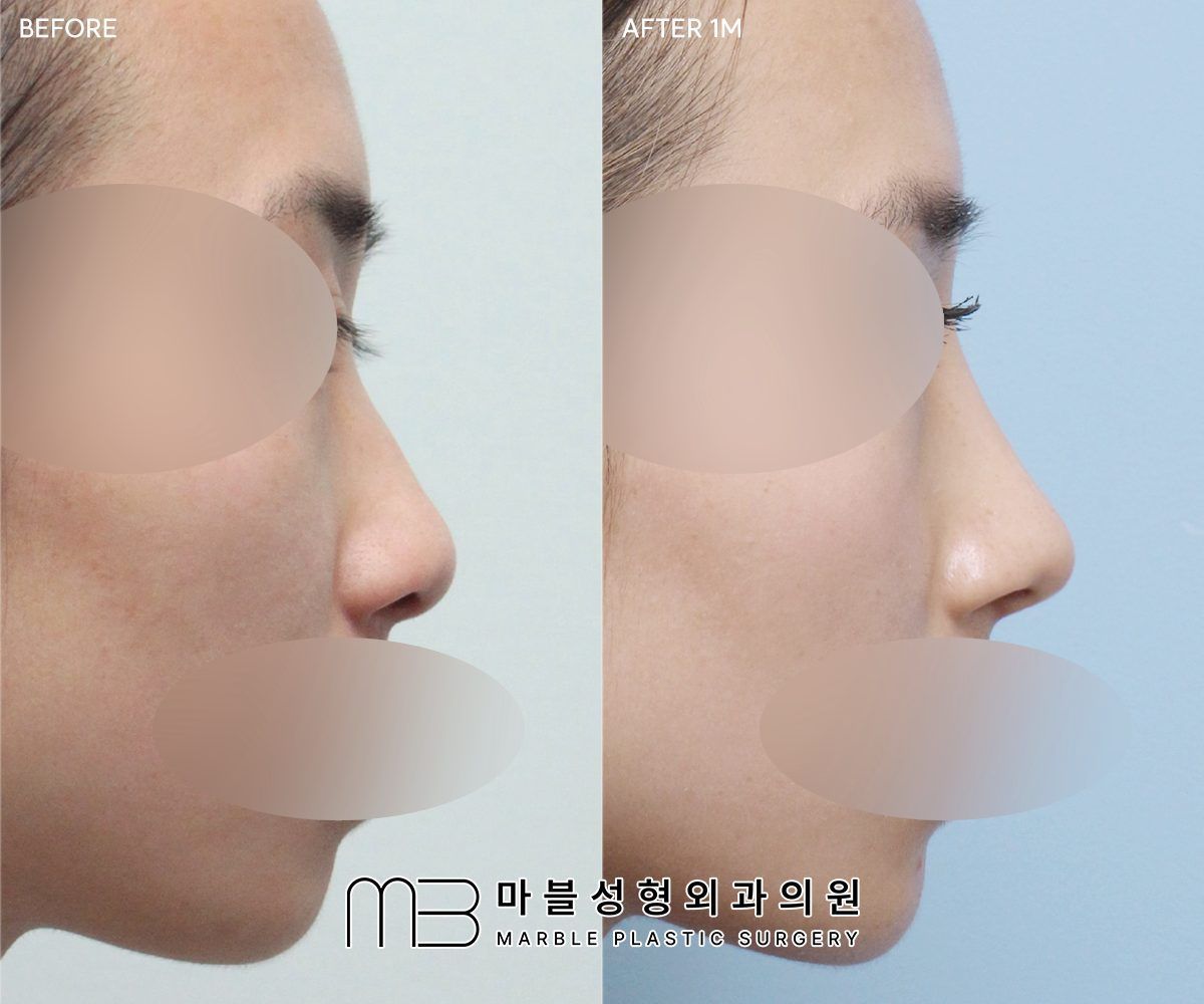 Before and after Rhinoplasty (bridge + tip) + bulbous tip correction + dorsal hump reduction + lateral osteotomy, side profile, 1 month after surgery — case 02, Marble Plastic Surgery Seoul