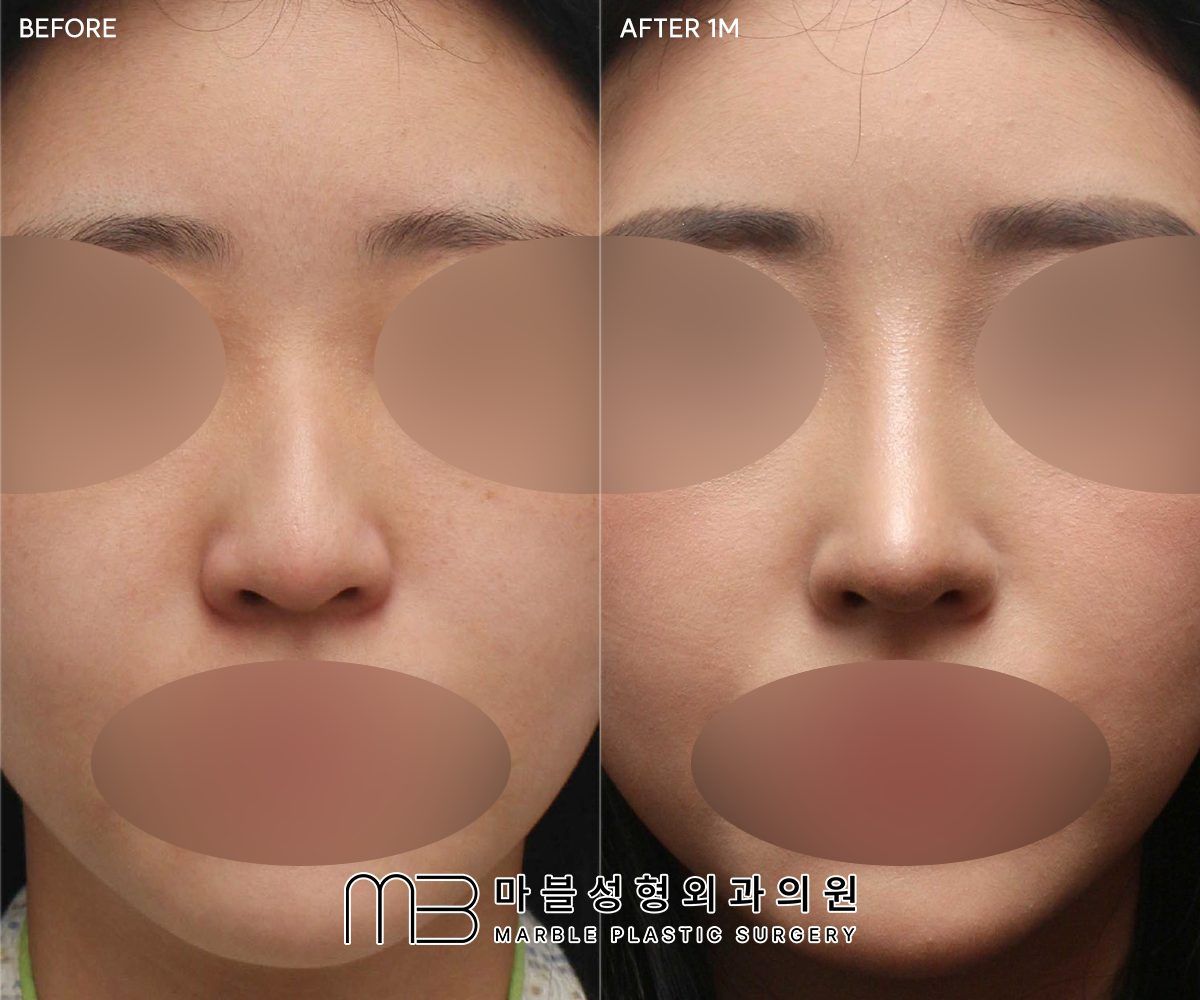 Before and after Rhinoplasty (bridge + tip) + dorsal hump reduction + bulbous tip correction + lateral osteotomy, front view, 1 month after surgery — case 03, Marble Plastic Surgery Seoul