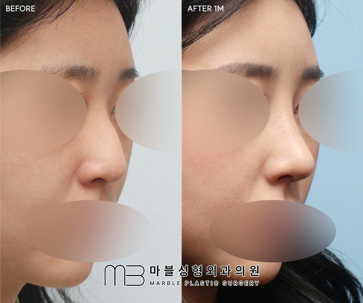 Before and after Rhinoplasty (bridge + tip) + dorsal hump reduction + bulbous tip correction + lateral osteotomy, 45° view, 1 month after surgery — case 03, Marble Plastic Surgery Seoul