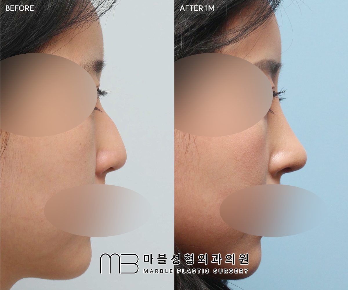 Before and after Rhinoplasty (bridge + tip) + dorsal hump reduction + bulbous tip correction + lateral osteotomy, side profile, 1 month after surgery — case 03, Marble Plastic Surgery Seoul