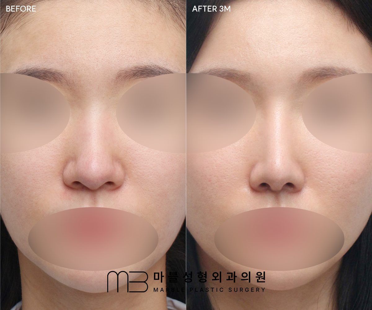 Wide Nose Surgery before and after at Marble Plastic Surgery, Seoul
