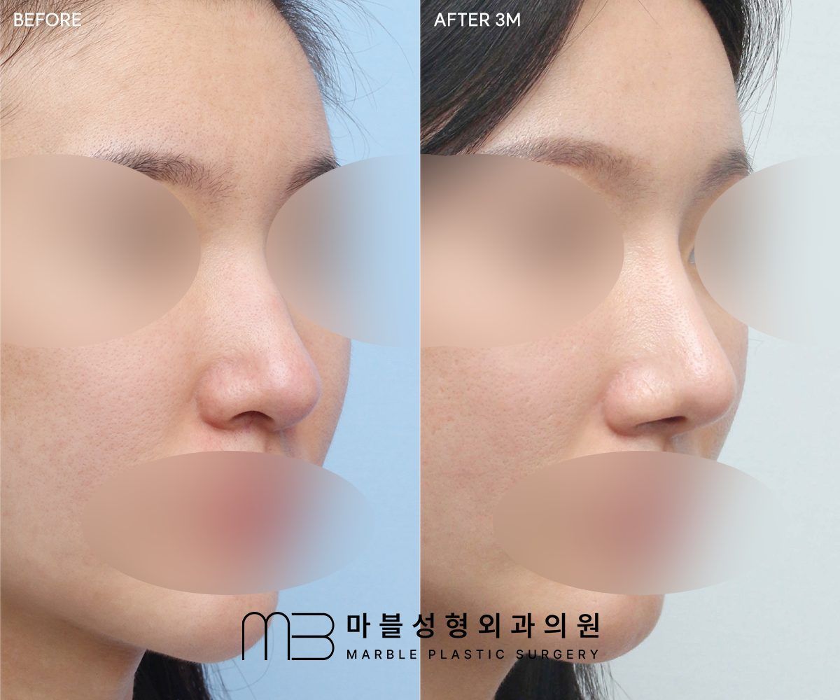 Before and after Rhinoplasty (bridge + tip) + dorsal hump reduction + lateral osteotomy, 45° view, 3 months after surgery — case 04, Marble Plastic Surgery Seoul
