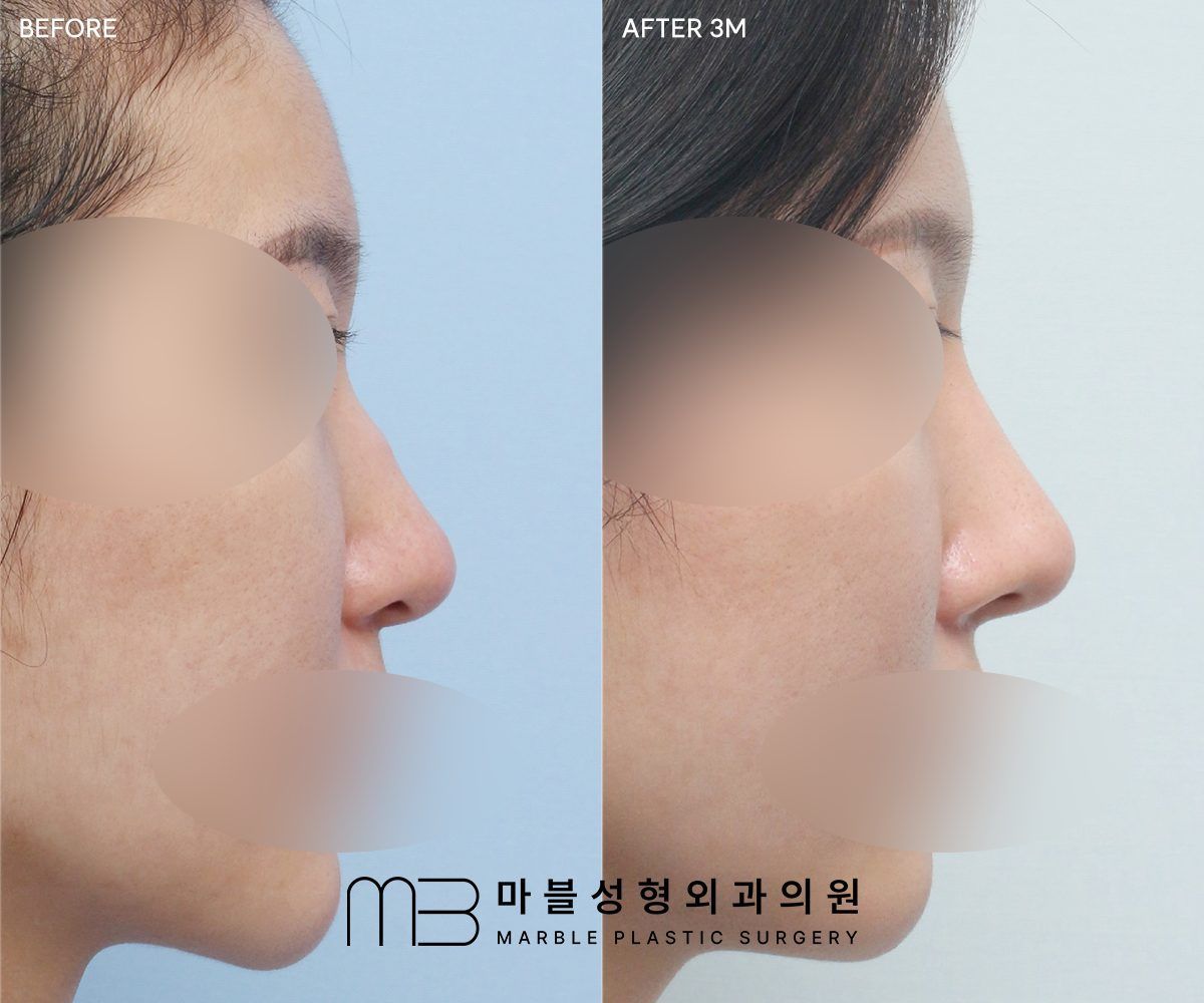 Before and after Rhinoplasty (bridge + tip) + dorsal hump reduction + lateral osteotomy, side profile, 3 months after surgery — case 04, Marble Plastic Surgery Seoul