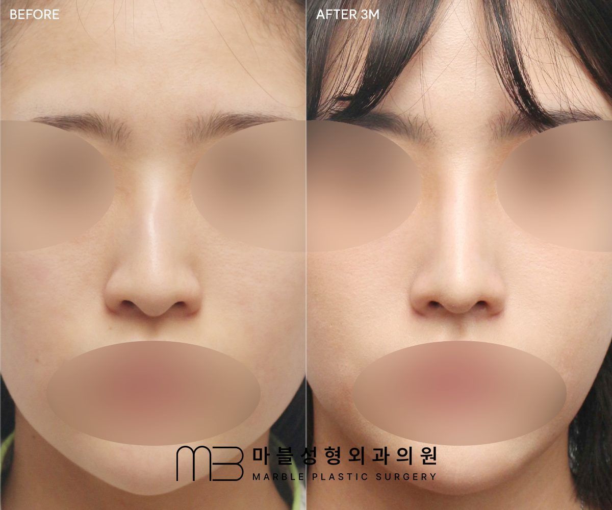Before and after Rhinoplasty (bridge + tip) + dorsal hump reduction, front view, 3 months after surgery — case 05, Marble Plastic Surgery Seoul