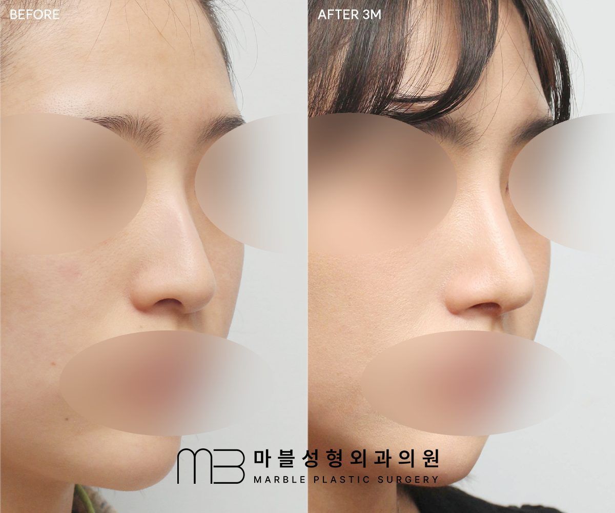 Before and after Rhinoplasty (bridge + tip) + dorsal hump reduction, 45° view, 3 months after surgery — case 05, Marble Plastic Surgery Seoul