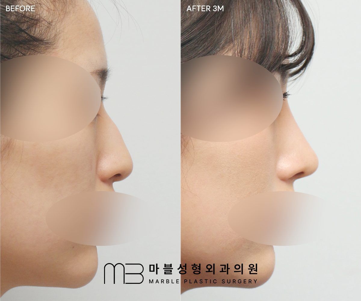 Before and after Rhinoplasty (bridge + tip) + dorsal hump reduction, side profile, 3 months after surgery — case 05, Marble Plastic Surgery Seoul