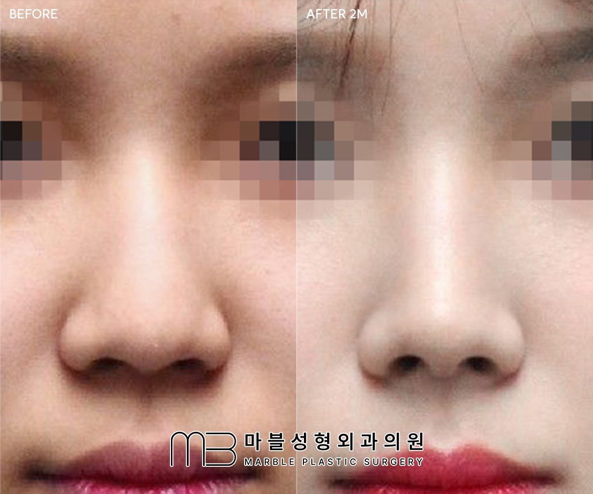 Bulbous Nose Surgery before and after at Marble Plastic Surgery, Seoul