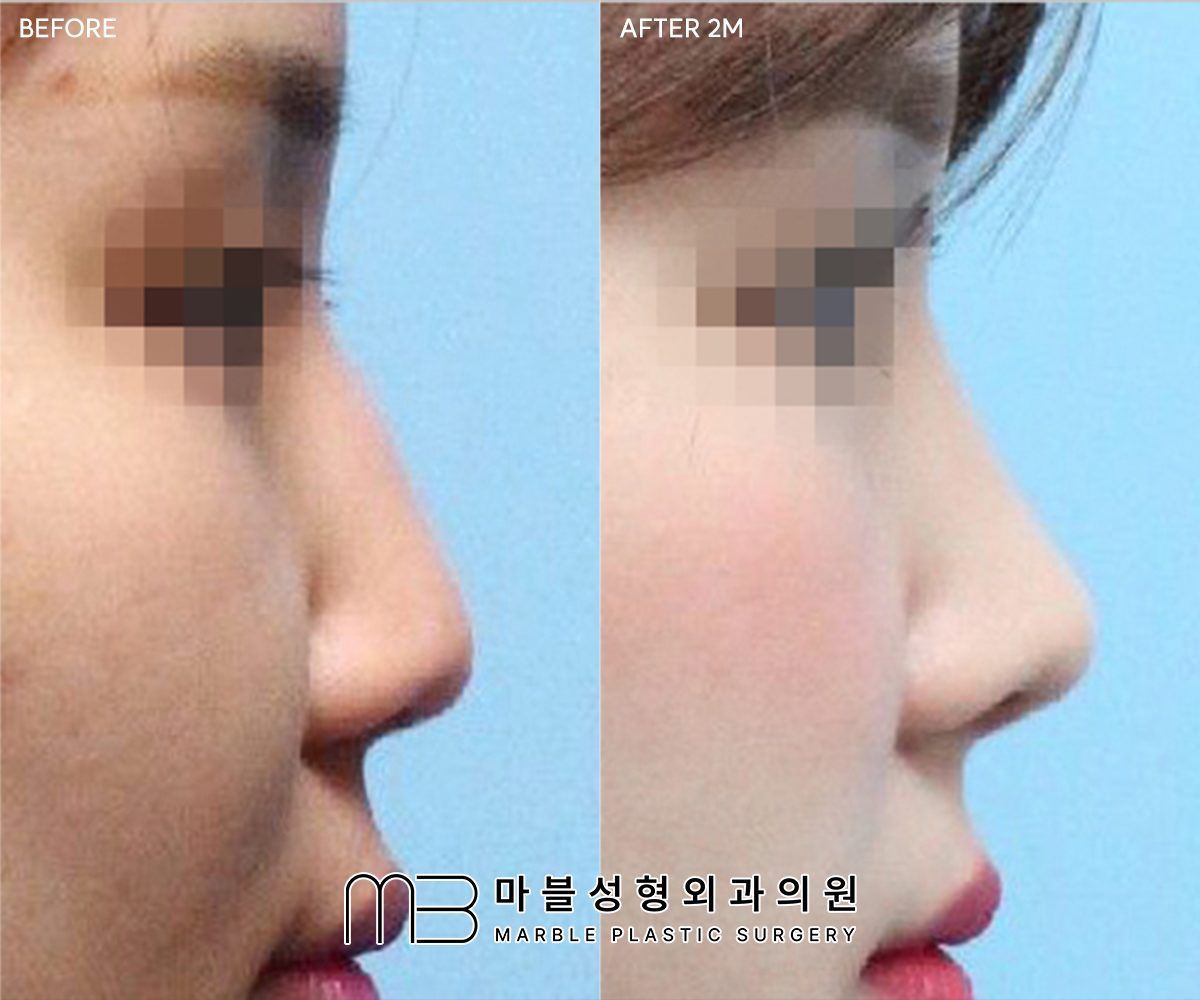 Before and after Rhinoplasty (bridge + tip) + dorsal hump reduction + bulbous tip correction, side profile, 2 months after surgery — case 06, Marble Plastic Surgery Seoul
