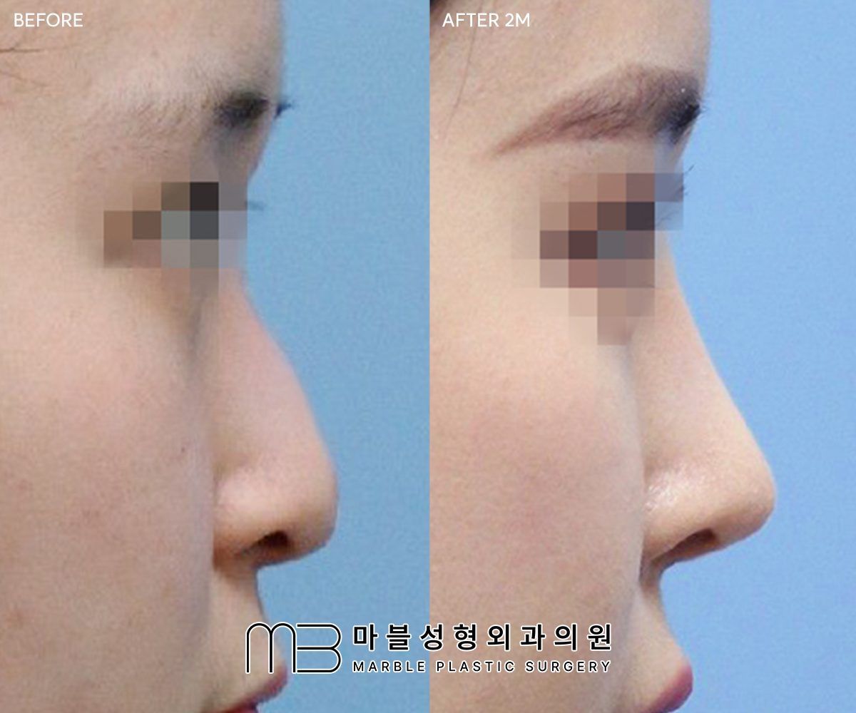 Dorsal Hump Reduction before and after at Marble Plastic Surgery, Seoul