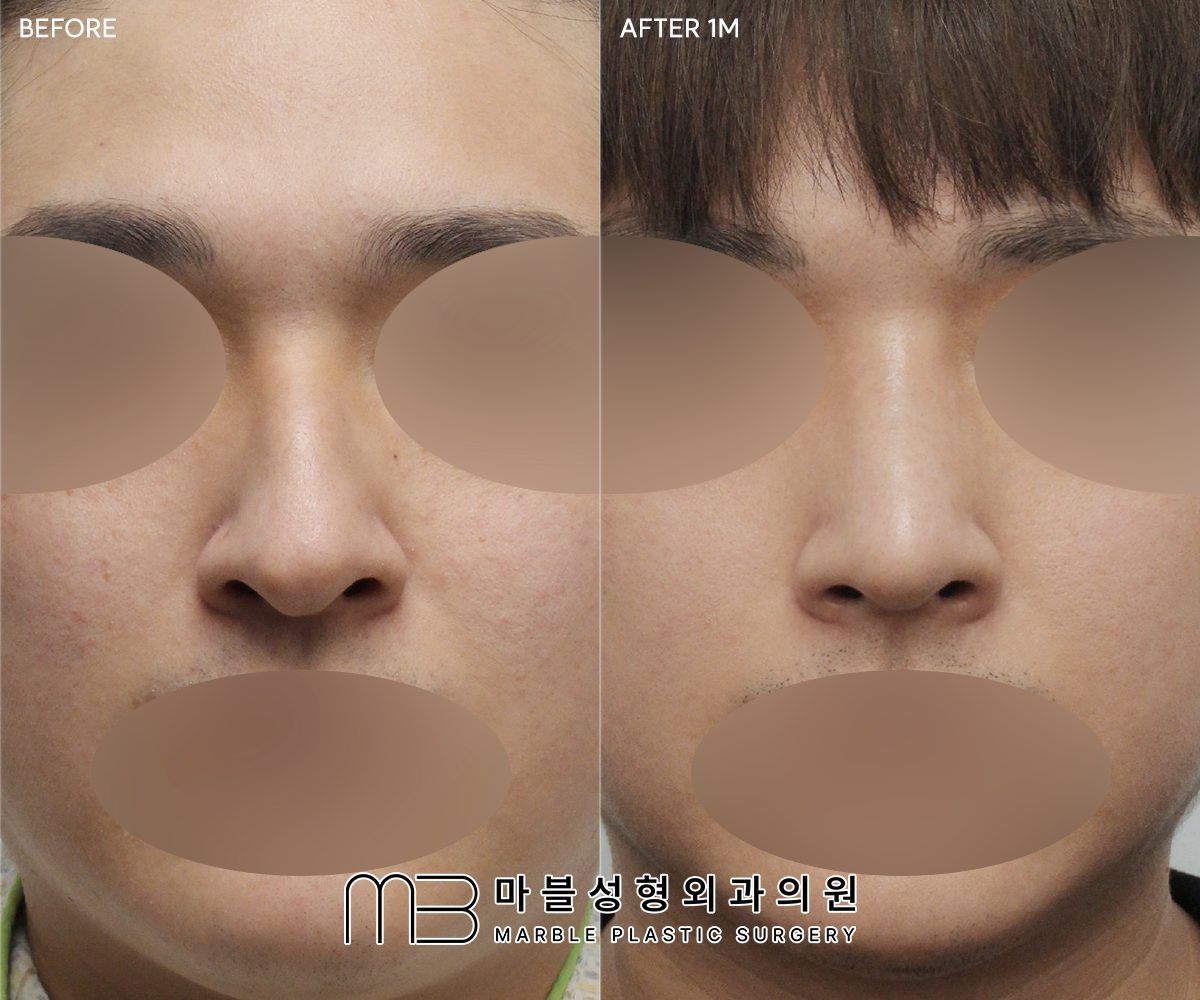 Before and after Tip plasty + dorsal hump reduction + lateral osteotomy, front view, 1 month after surgery — case 08, Marble Plastic Surgery Seoul