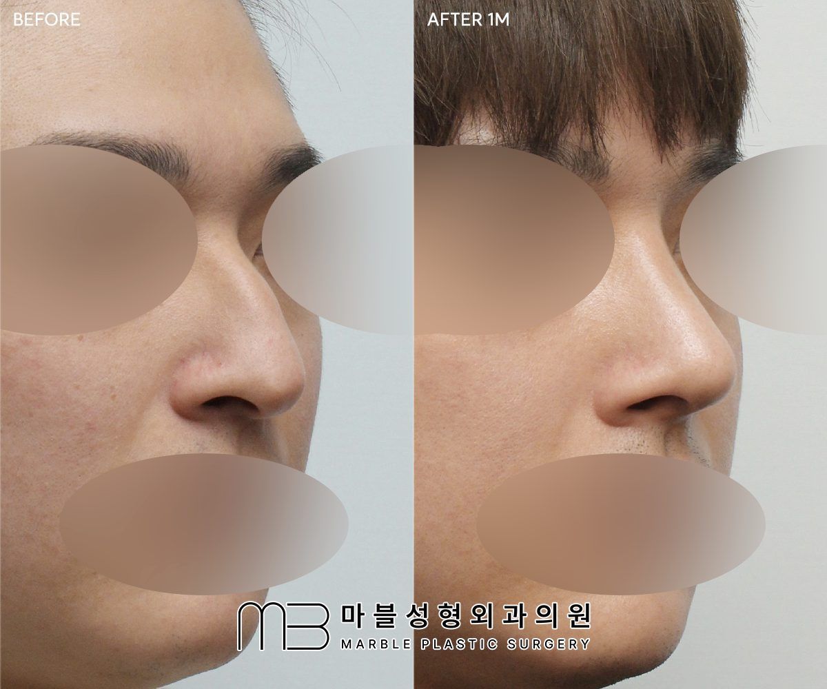 Tip Plasty before and after at Marble Plastic Surgery, Seoul