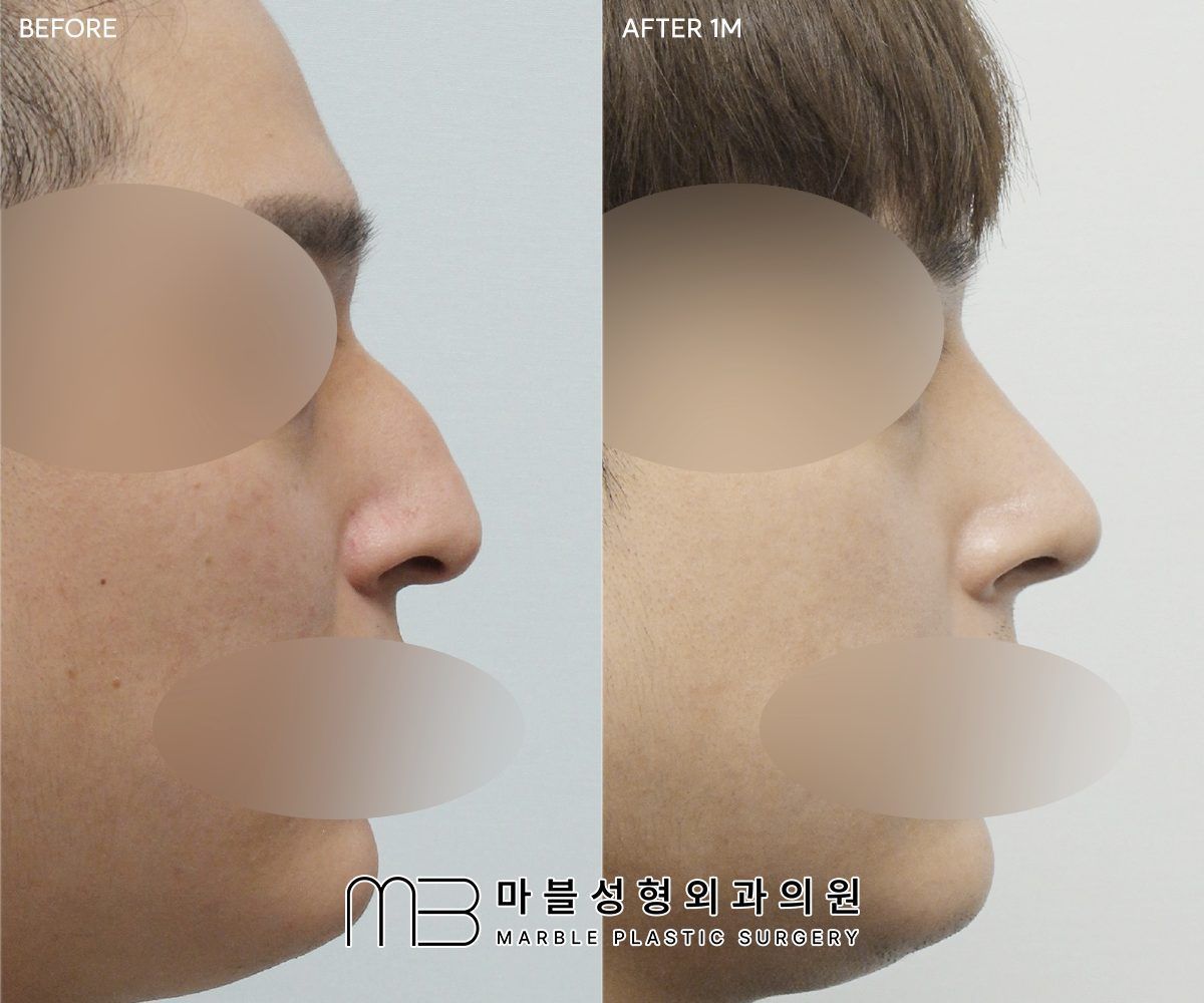Before and after Tip plasty + dorsal hump reduction + lateral osteotomy, side profile, 1 month after surgery — case 08, Marble Plastic Surgery Seoul