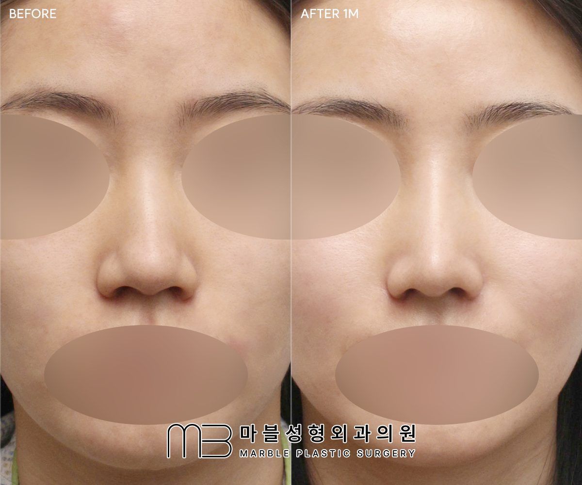 Before and after Rhinoplasty (bridge + tip) + dorsal hump reduction + bulbous tip correction + lateral osteotomy, front view, 1 month after surgery — case 09, Marble Plastic Surgery Seoul