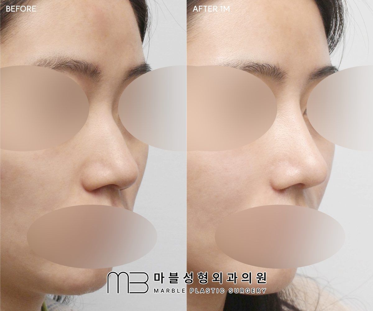 Before and after Rhinoplasty (bridge + tip) + dorsal hump reduction + bulbous tip correction + lateral osteotomy, 45° view, 1 month after surgery — case 09, Marble Plastic Surgery Seoul