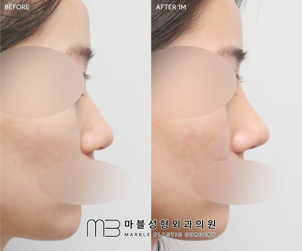 Before and after Rhinoplasty (bridge + tip) + dorsal hump reduction + bulbous tip correction + lateral osteotomy, side profile, 1 month after surgery — case 09, Marble Plastic Surgery Seoul