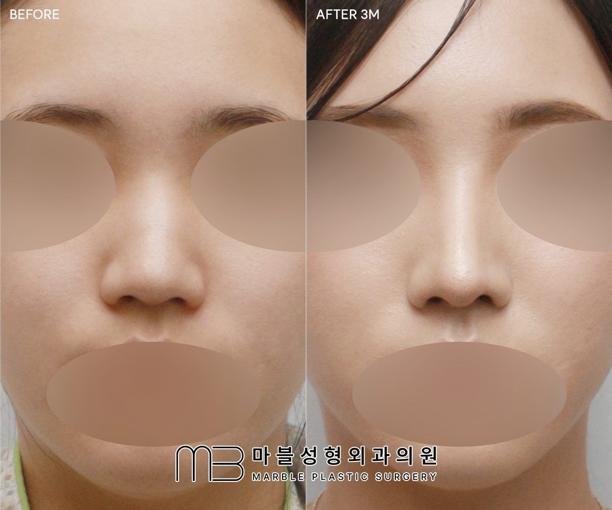 Rhinoplasty before and after at Marble Plastic Surgery, Seoul