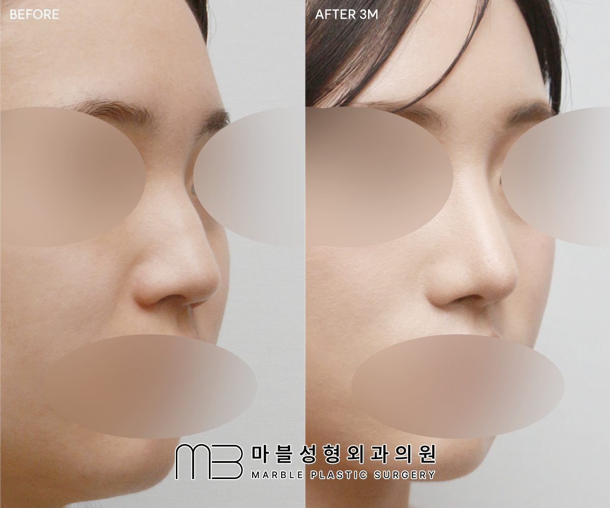 Before and after Rhinoplasty (bridge + tip) + dorsal hump reduction + bulbous tip correction + lateral osteotomy, 45° view, 3 months after surgery — case 10, Marble Plastic Surgery Seoul