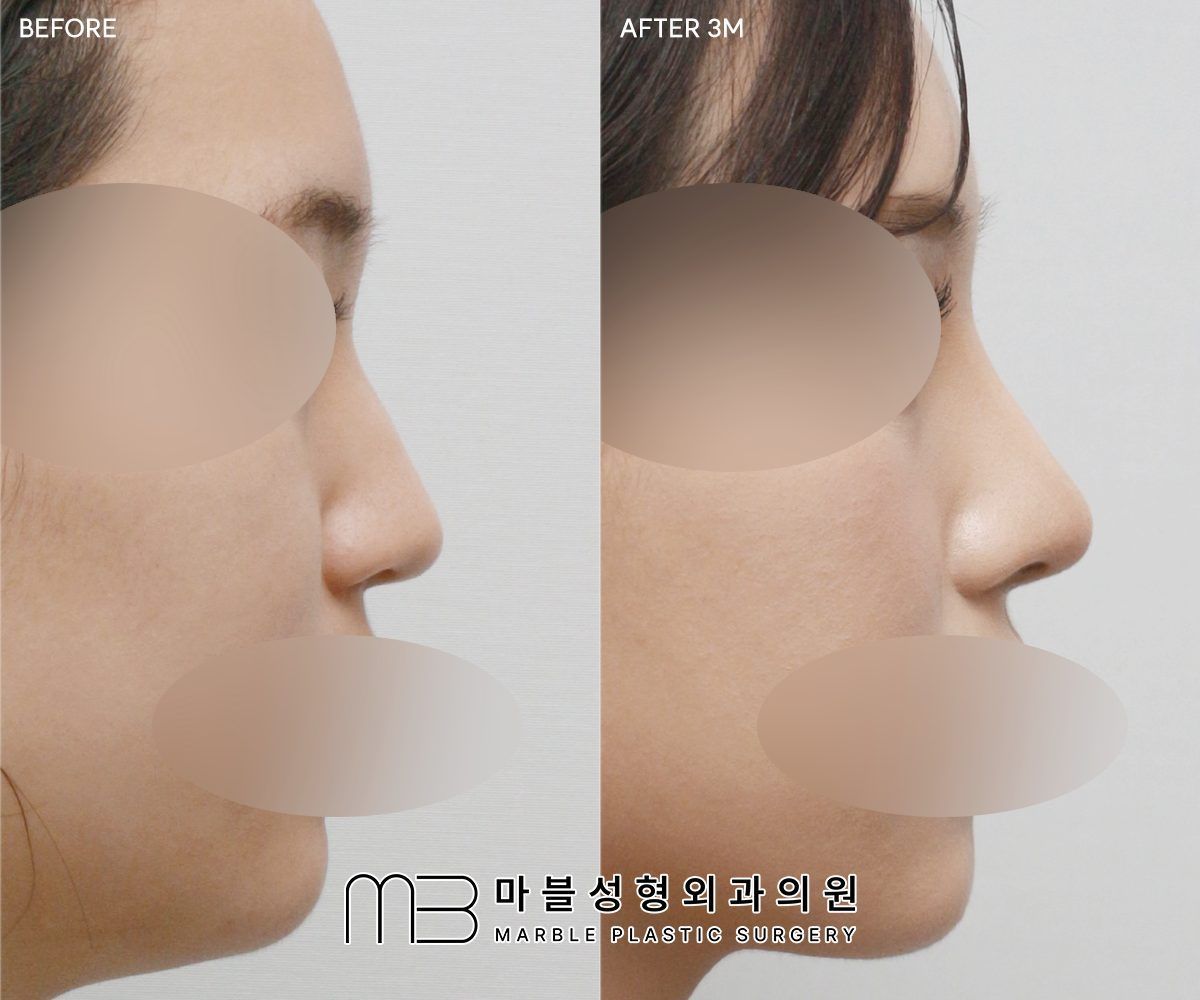 Before and after Rhinoplasty (bridge + tip) + dorsal hump reduction + bulbous tip correction + lateral osteotomy, side profile, 3 months after surgery — case 10, Marble Plastic Surgery Seoul