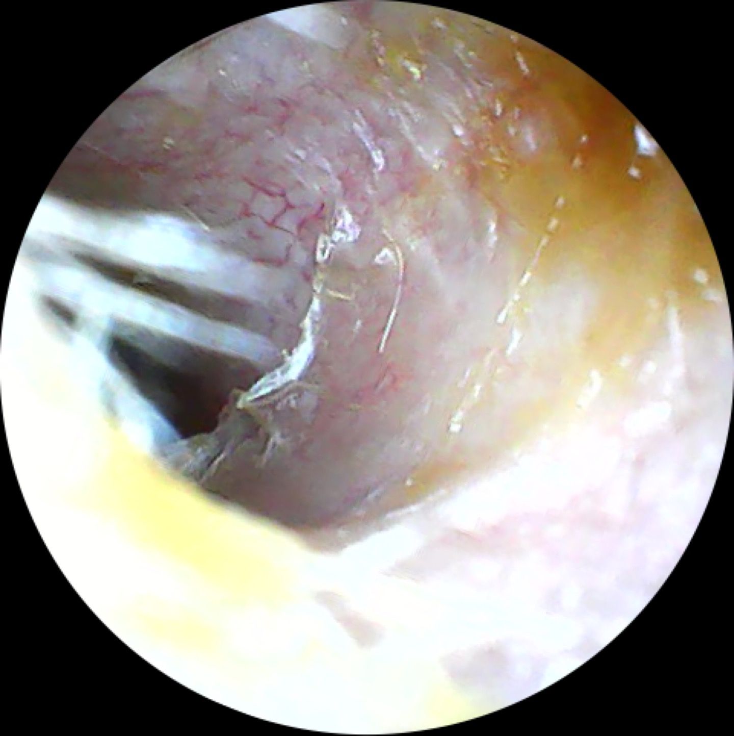 Happy Ears Ear Wax Removal Nottingham - inside a clean ear