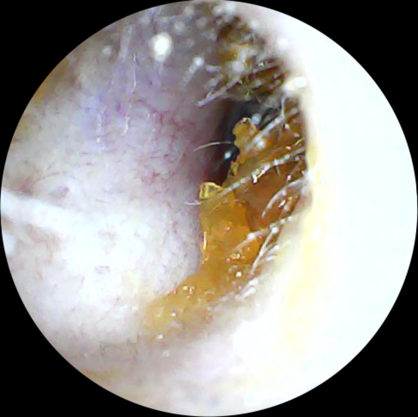 Happy Ears Ear Wax Removal Nottingham - inside an ear with wax