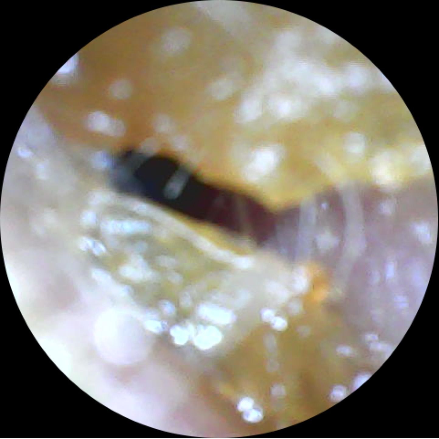 Happy Ears Ear Wax Removal Nottingham - inside an ear with a lot of wax