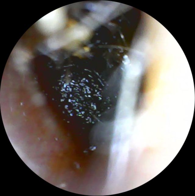 Camera view of an ear canal blocked by old, dark, compacted wax