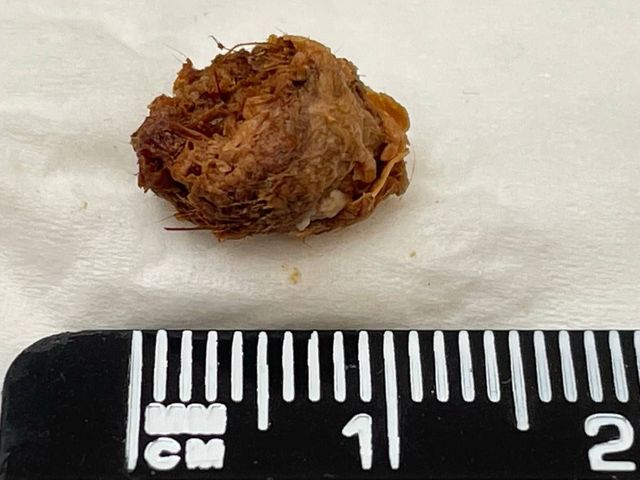A plug of ear wax about a centimetre across, removed by irrigation at Happy Ears