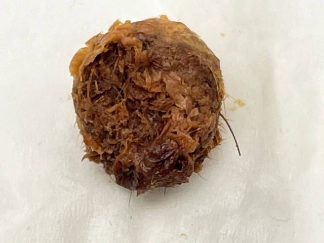 Close-up of a compacted plug of ear wax and hair removed by irrigation