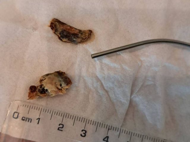 Two pieces of ear wax removed by microsuction for a Sherwood patient, next to the suction tube and a ruler