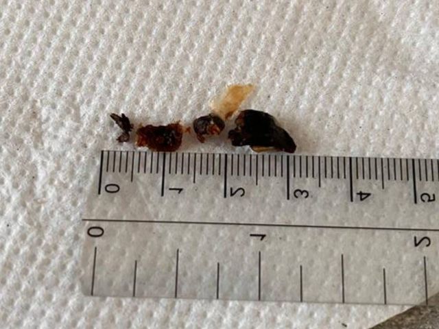 Small pieces of ear wax removed by microsuction for a Mapperley patient, next to a ruler
