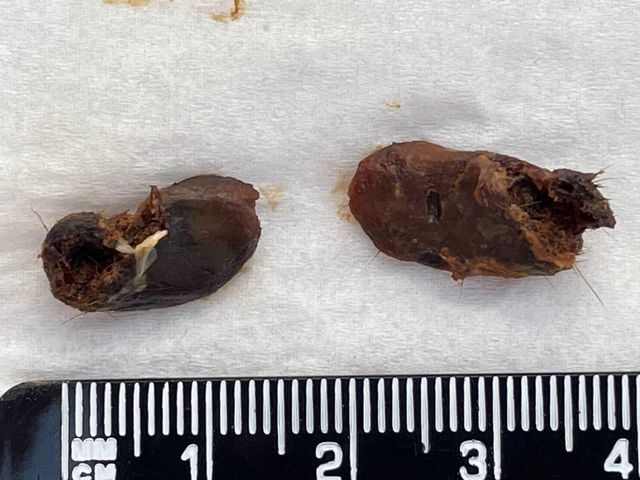 Two pieces of removed compacted ear wax, each over a centimetre long, next to a ruler