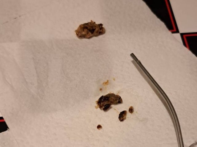 Pieces of removed ear wax next to a microsuction tube