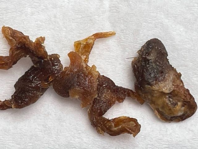 Strands and a plug of compacted ear wax removed by microsuction