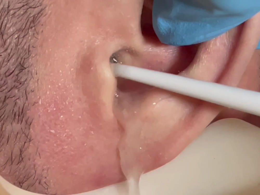 Warm water ear irrigation in progress, with the irrigator tip at the entrance of the ear canal and a bowl under the ear
